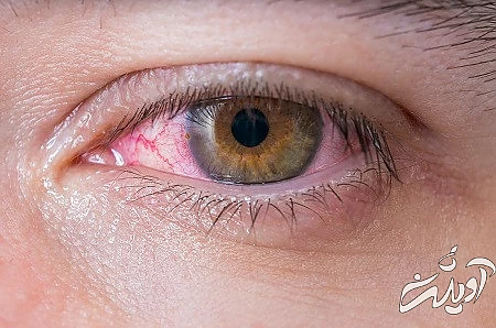 علت رنگ پریدگی صورت, چشم های پف کرده ناشی از کمبود های تغذیه ای, علت خشکی پوست